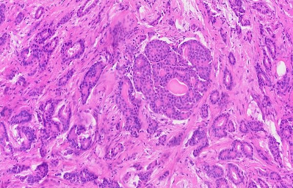 在涎腺癌中,perineural invasion的预测价值:一项比较性meta分析。