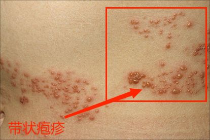 带状疱疹是身体免疫在预警