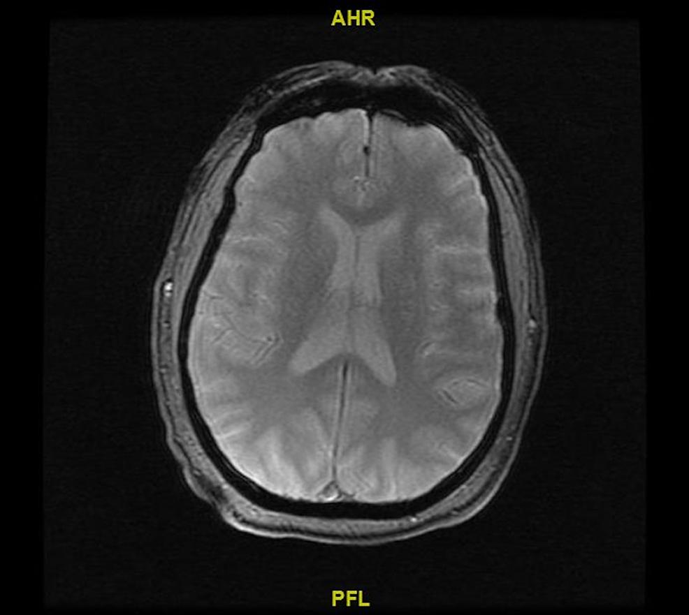 Un sorprendente descubrimiento del cereb
