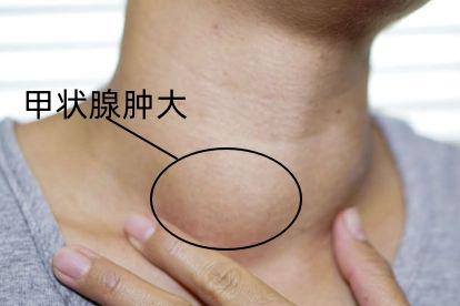 深圳永福医院：低甲亢的危害有那些呢？