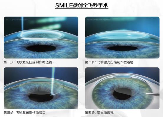 สุขภาพทางการแพทย์ SMILE ตลอดวินาที เทคโนโลยีและความงาม